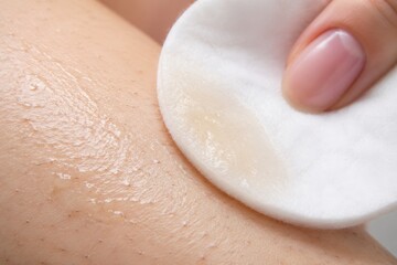 Fototapeta premium Woman applying cosmetic lotion with cotton pad on leg after hair removal session. Skincare routine for smooth skin. Procedure for body care, dermatological treatment and epilation concept.