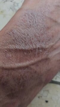 Close up of a human foot exhibiting severe dry scaly and cracked skin texture indicative of xerosis or eczema dermatological conditions