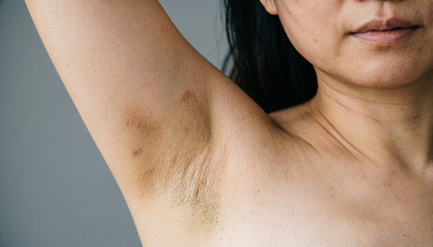 An close-up of an Asian woman's hyperpigmented underarm under soft studio lighting. Generative AI