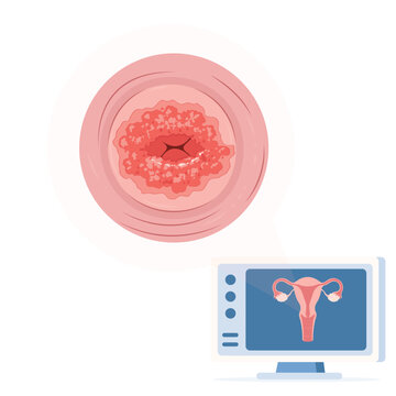 Medical vector illustration of cervical erosion showing inflamed cervical tissue. Ideal for educational content about gynecological disorders, reproductive health, and cervical examination.