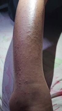 Close up of a human arm displaying small raised bumps indicative of keratosis pilaris miliaria or a papular skin rash