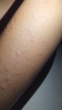 Close up of a person's skin with a rash and small bumps caused by chikungunya infection