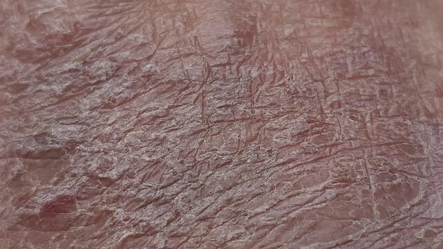 Close up view of severely dry cracked and flaky human skin showing symptoms of a dermatological condition such as eczema psoriasis or ichthyosis with visible rough texture and scaling
