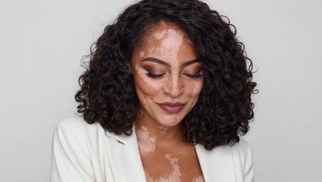 Real woman with vitiligo skin and dark curly hair in white blazer beauty portrait