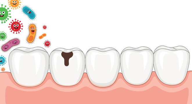 Row of white human teeth on pink gums with one tooth showing a large brown cavity as colorful cartoon bacteria approach to attack.