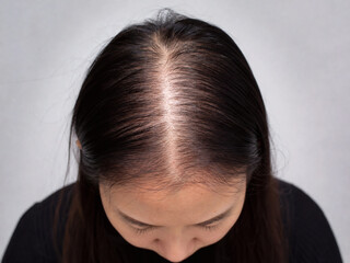 Fototapeta premium Female Pattern Hair Loss Showing Widened Part Line on Scalp Close Up