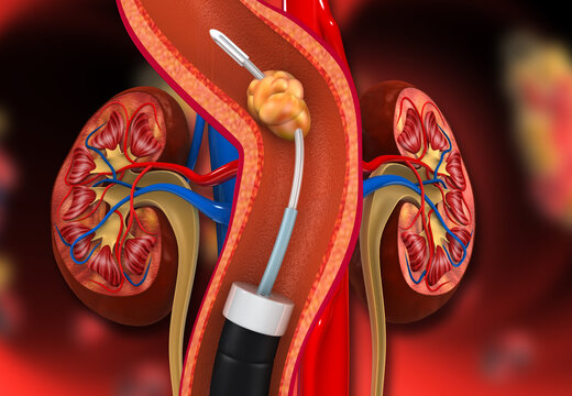 Detailed medical illustration of a human kidney cross-section showing anatomical structures and surgical stone removal.