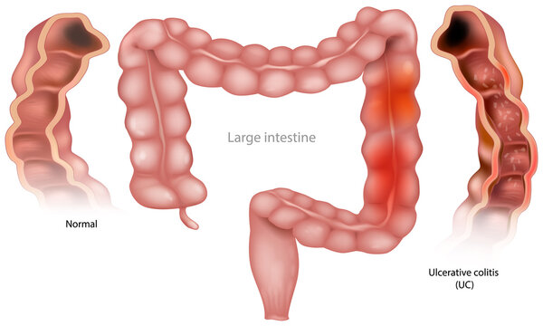 Ulcerative Colitis Gi