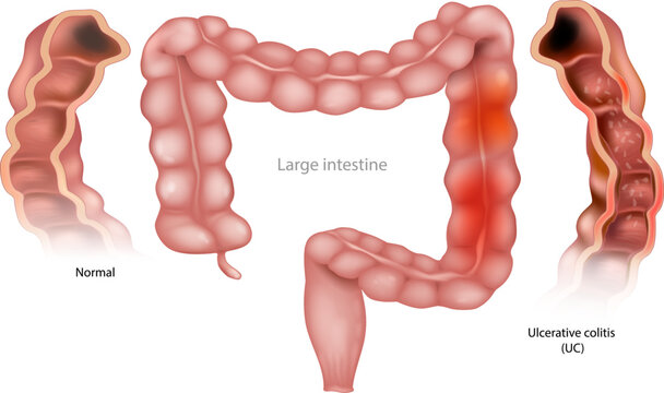 Ulcerative Colitis Medical Illustration of Inflamed Large Intestine. Colon Inflammation, Digestive Disorder and Intestinal Anatomy. Gastrointestinal Disease