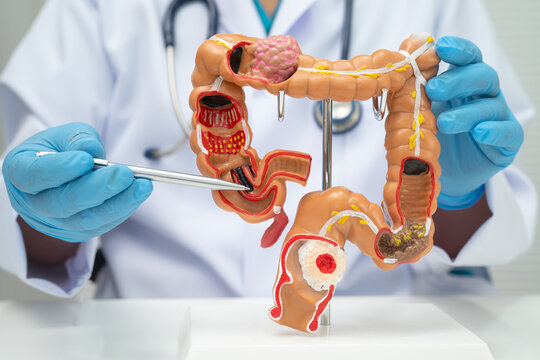 Colorectal cancer, doctor holding intestine colon human anatomy model.