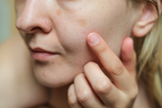 Close-up of woman face showing pigmentation spots and uneven skin tone. Hyperpigmentation, melasma, skincare concerns, dermatology, cosmetic treatment and facial skin health. Beauty awareness