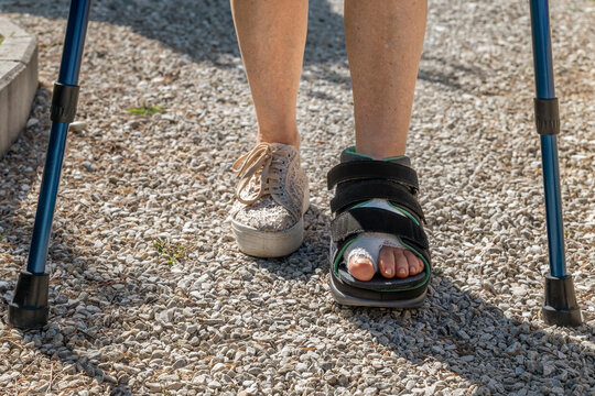 A woman who underwent surgery to correct her bunions begins walking again with the help of crutches and a special shoe with velcro closures