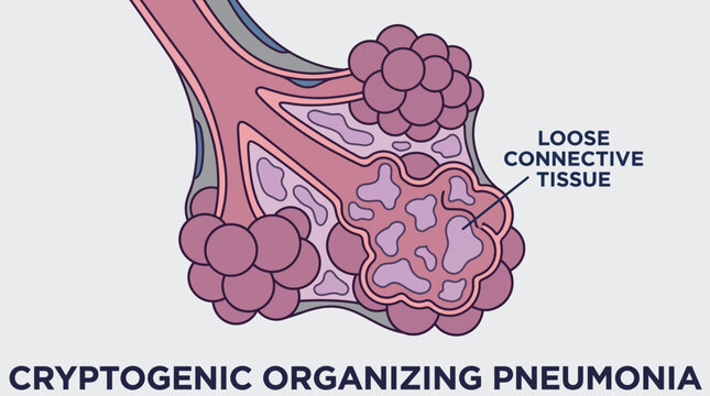 Cryptogenic Organizing Pneumonia Loose Connective Tissue in Alveoli