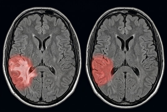 Brain MRI highlighting a lesion in the somatosensory cortex.