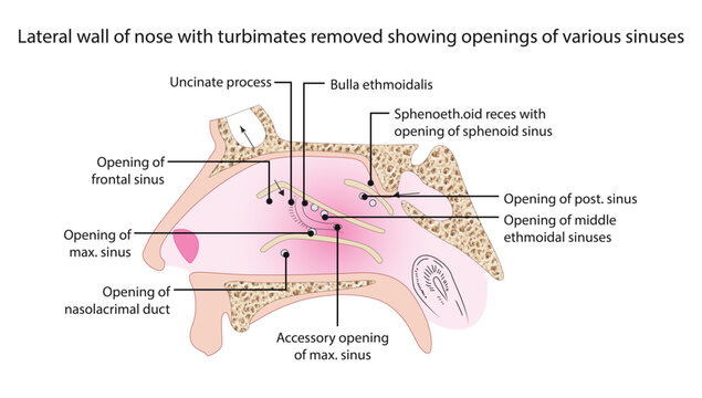 Lateral wall of nose with turbimates removed showing openings of various sinuses, the lateral nasal wall with turbinates removed, highlighting the drainage pathways.