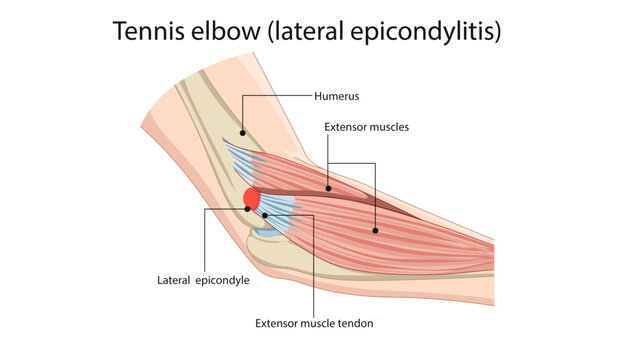 Tennis Elbow (Lateral Epicondylitis) Anatomy, lateral epicondylitis (tennis elbow), showing inflammation and microtears of the common extensor tendon at the lateral epicondyle.