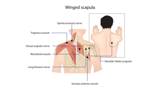 Winged Scapula Due to Long Thoracic Nerve Palsy, winged scapula caused by serratus anterior paralysis, highlighting the role of the long thoracic nerve in scapular stabilization.