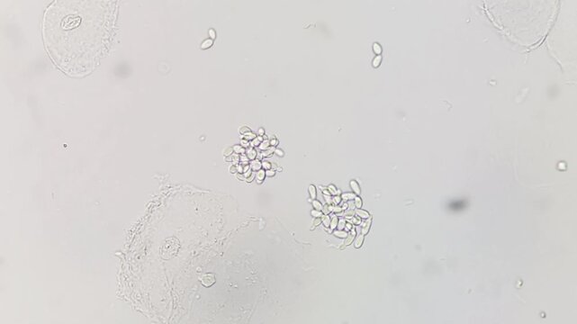 Yeast or candida cells and epithelial cells under microscope. Urine microscopy showing Yeast cells.