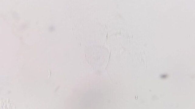 Yeast or candida cells and epithelial cells under microscope. Urine microscopy showing Yeast cells.