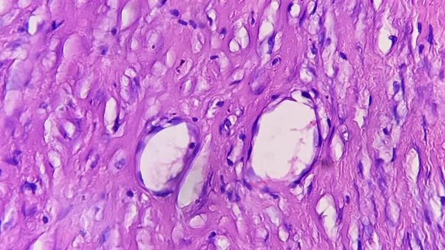 Histopathology of right breast lump. Infiltrating ductal carcinoma (nst), well differentiated G-1. Section of breast tumour reveal features of an infiltrating ductal carcinoma. 