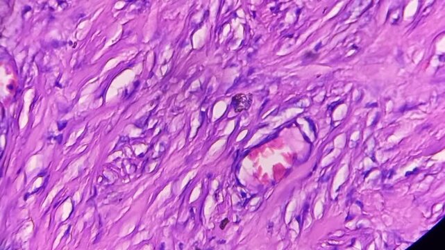 Histopathology of right breast lump. Infiltrating ductal carcinoma (nst), well differentiated G-1. Section of breast tumour reveal features of an infiltrating ductal carcinoma. 