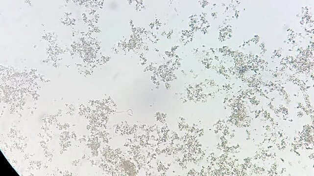 Amorphous Phosphate in urine under microscope. Urine microscopy showing amorphous Phosphate.