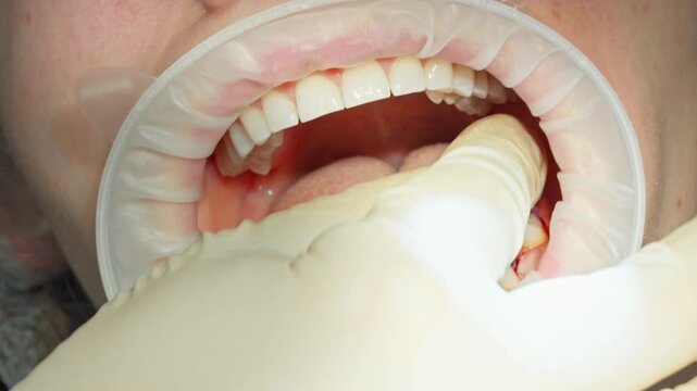 A close-up of a dentist screwing the first titanium part of a dental implant into a patient's jaw with a driver