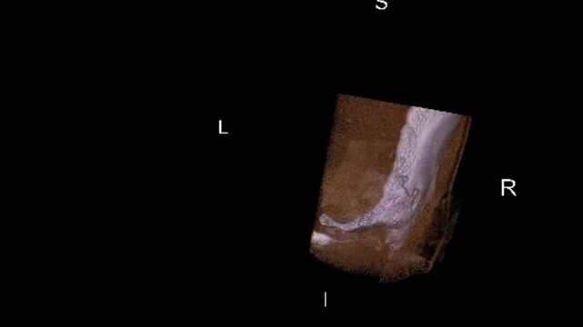 HRCT 3D Scan Rotation of Temporal Bone Showing Auditory Ossicles Inner Ear and Mastoid Air Cells