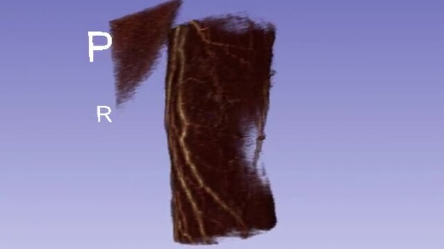 3D MRI Scan Rotation of Right Wrist Joint Showing Carpal Bones Radius Ulna and Soft Tissue Anatomy