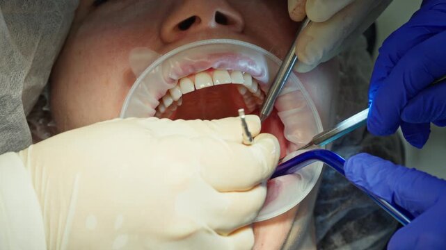 A professional dentist performs a precise check of a parallel guide pin during the surgical stage of dental implant placement