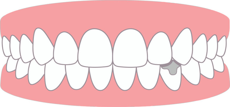 Amalgam Metal Dental Filling Illustration