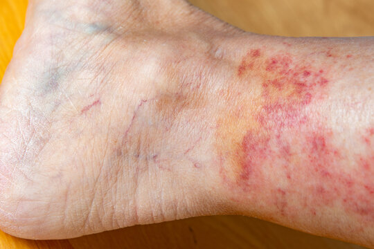 Red rash on the interior ankles of a woman with a shallow depth of field	