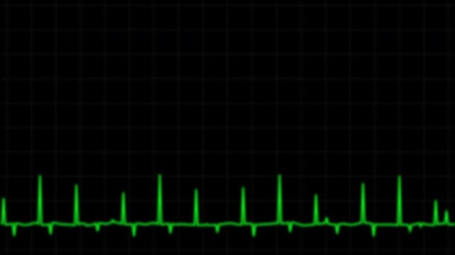 Cardiograph Recording | Classic thermal paper printout with green ecg rhythm heart monitor, suitable for medical websites, presentations, and publications related to cardiology. On transparent backgro