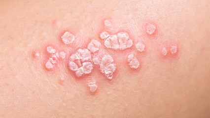 Fototapeta premium Skin rash, herpes zoster, shingles, viral infection, close-up