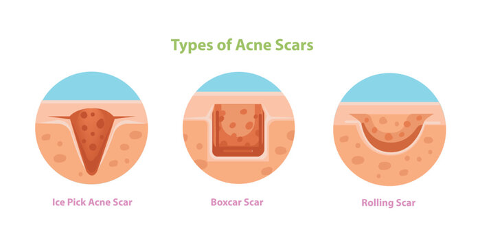 Types of Acne Scars Illustration Ice Pick, Boxcar and Rolling Scars