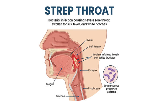 Medical illustration showing strep throat infection with swollen tonsils, white patches, and bacterial cause.