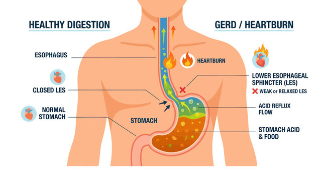 Human Stomach Anatomy: Healthy Digestion vs GERD/Heartburn Acid Reflux