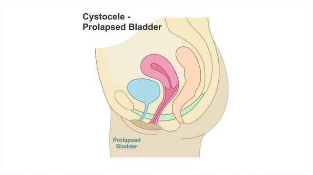 Cystocele or prolapsed bladder educational medical illustration showing bladder descent into the vagina due to weakened pelvic floor muscles. OB-GYN concept, 4K, white background.