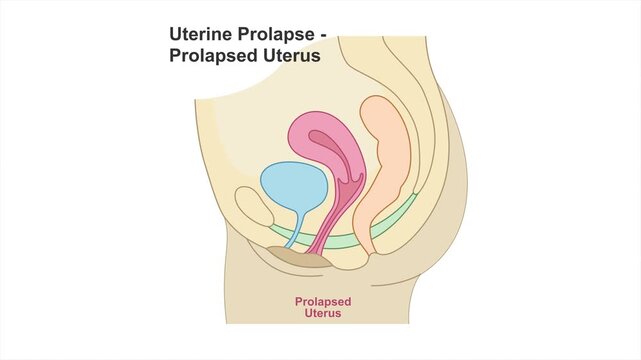 Uterine prolapse medical illustration showing descent of the uterus into the vagina caused by weakened pelvic floor support. Women's health educational concept, 4K, white background.