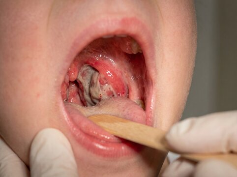 Close up of diphtheria pseudomembrane on child swollen tonsil
