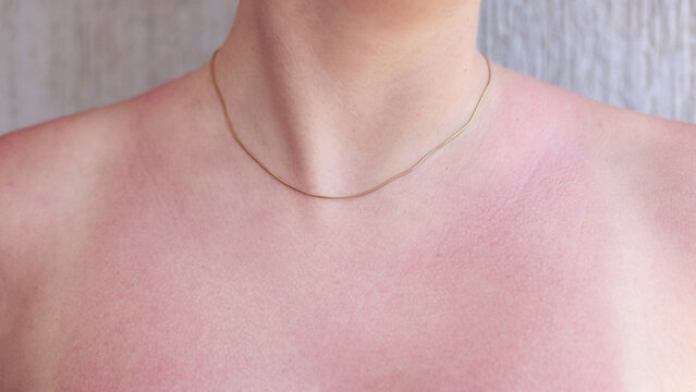 Close-up of red sunburned shoulder and upper back with soothing after sun cream applied to irritated skin, summer skincare and sun protection concept.