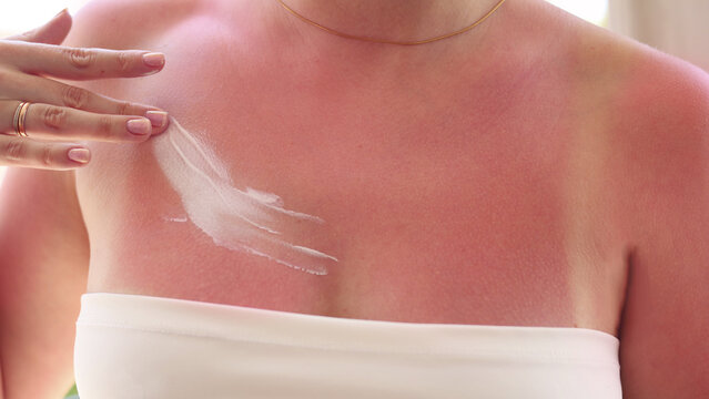 Woman with painful sunburned skin on chest and shoulders after summer vacation, close-up of red irritated skin with tan lines, after sun care and UV protection concept.