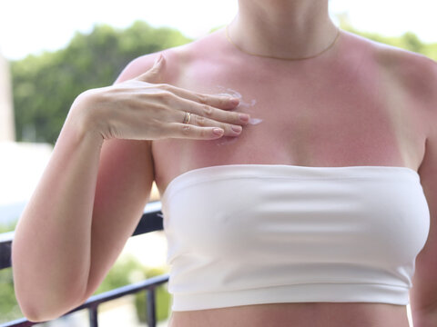Woman applying soothing cream to red sunburned chest and shoulder with visible tan lines, close-up of after sun skincare, moisturizing lotion and irritated skin care after beach vacation.