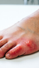 Fototapeta premium Close-up of a human toe with redness and swelling, showing inflamed skin, possible gout or infection, resting on clean white medical surface, highlighting foot health issues.