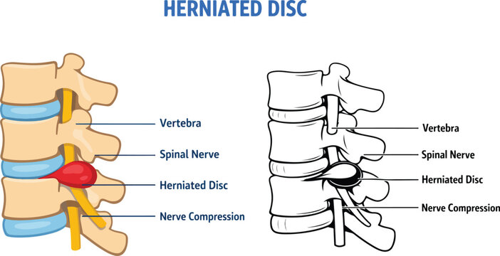 Herniated Disc Spine Anatomy Infographic | Side View Spinal Disc Compression Medical Vector Illustration