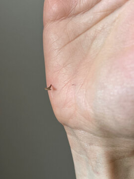 Macro view of a small thorn embedded in human hand skin after contact with a plant