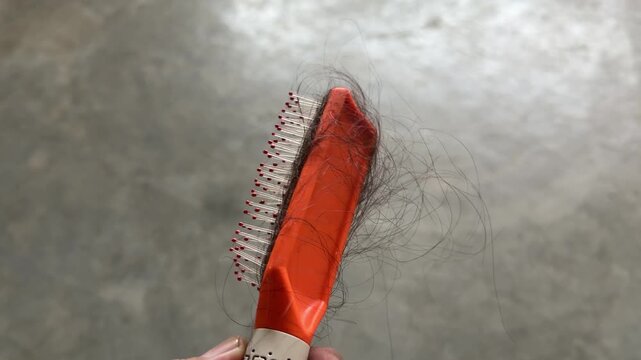 A woman&rsquo;s hand holds a hairbrush filled with fallen strands, showing excessive hair loss from thinning, weak, or damaged hair after brushing.