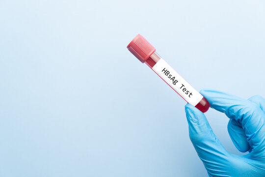 Blood sample tube with HBsAg test label on medical laboratory technologist hands over blue background. A blood test used to detect the presence of the hepatitis B virus. World hepatitis day concept.