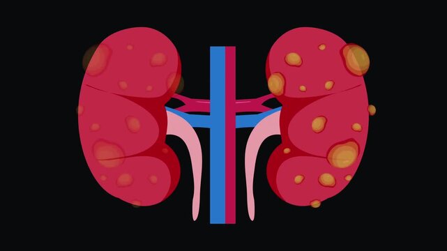 Illustration of polycystic kidneys showing multiple cysts kidney anatomy medical disease renal kidney anatomy medical disease renal