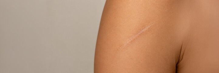 Fototapeta premium Healed scar on upper arm and shoulder in close up, skin recovery, dermatology, medical treatment, healthcare concept